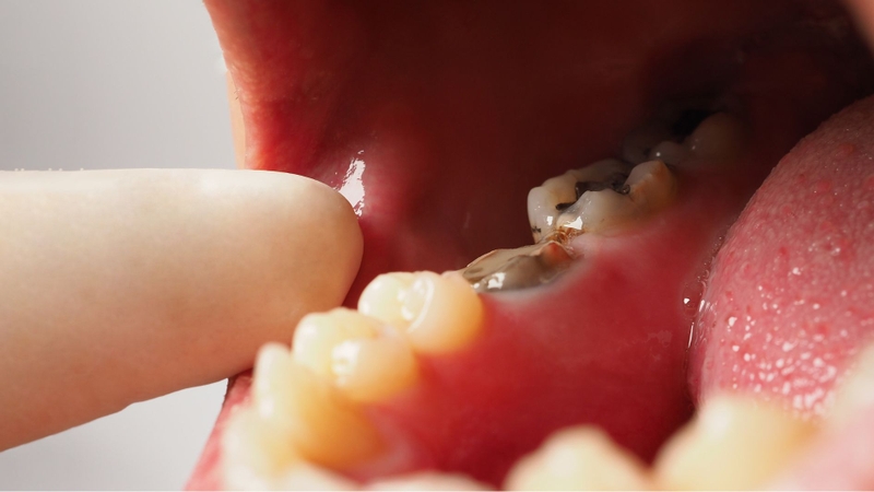 Răng bị sâu lỗ to có trám được không?