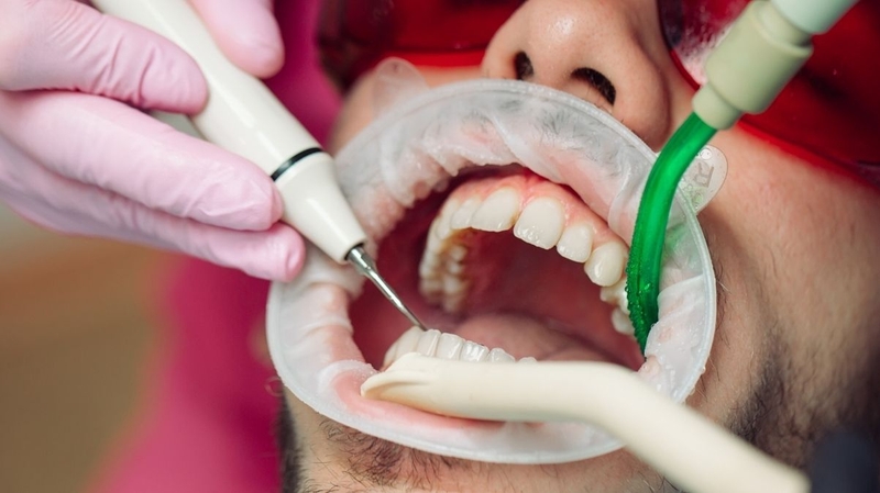 Lấy cao răng định kỳ giúp loại bỏ mảng bám gây bệnh nha chu