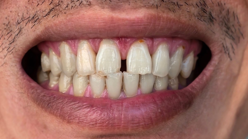 Răng thưa sau lấy cao răng không thể tự hết