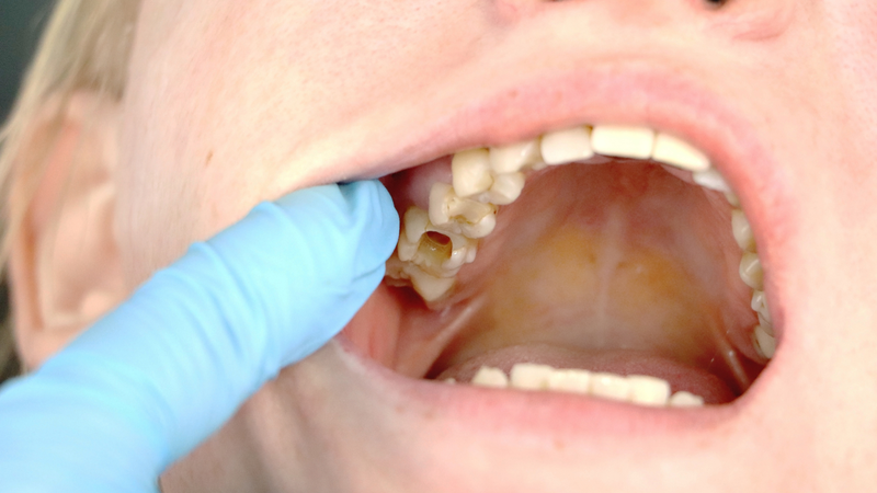 Nằm sâu trong hàm khiến mảng bám và vi khuẩn dễ tích tụ, làm tăng nguy cơ sâu răng