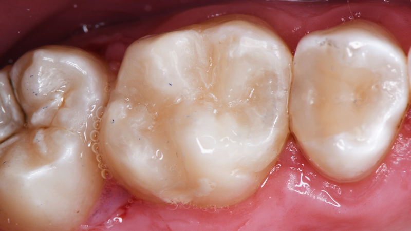 Răng khôn có thể phải nhổ nếu gây biến chứng