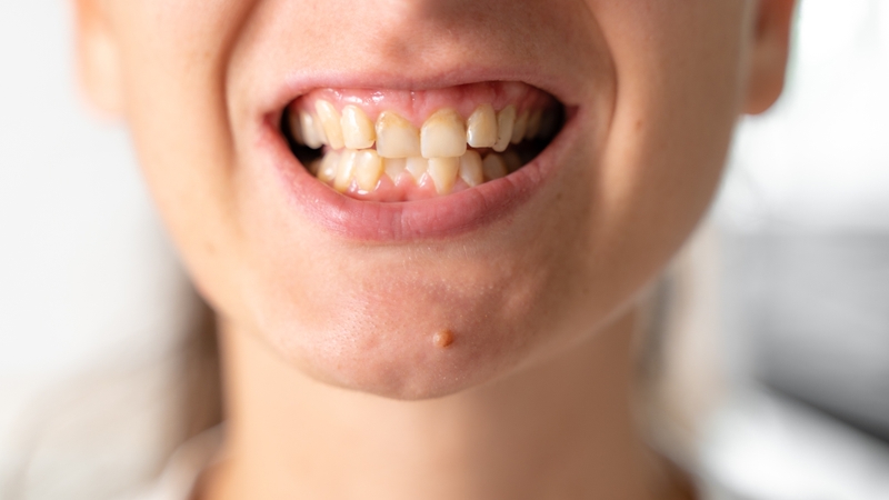Sai khớp cắn, răng mọc lệch có thể khiến răng cắn vào lưỡi thường xuyên