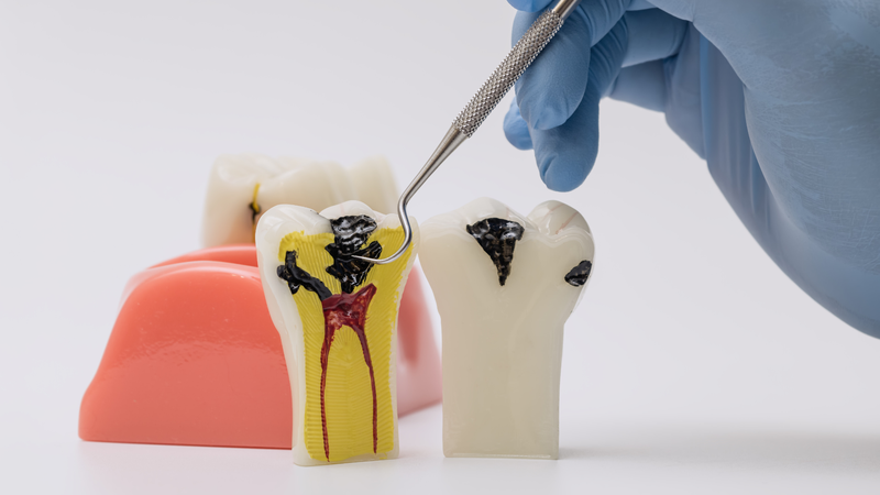 "Răng chết tủy là gì?" là thắc mắc của nhiều người