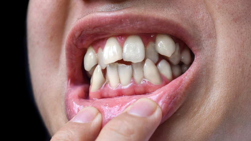 Răng chìa ra ngoài là tình trạng răng mọc lệch, nhô ra phía trước so với răng ở hàm đối diện