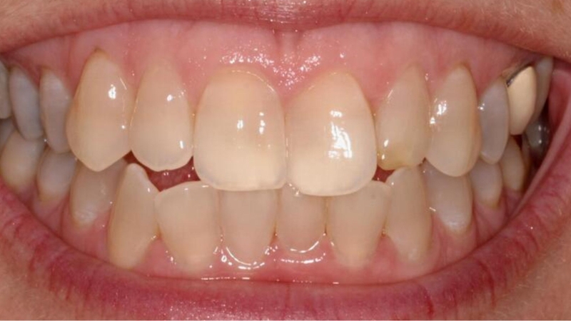 Răng cửa bị đổi màu là tình trạng răng không còn giữ màu sắc tự nhiên
