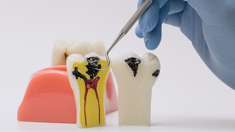 Răng chết tủy là nguyên nhân khiến răng bị đổi màu