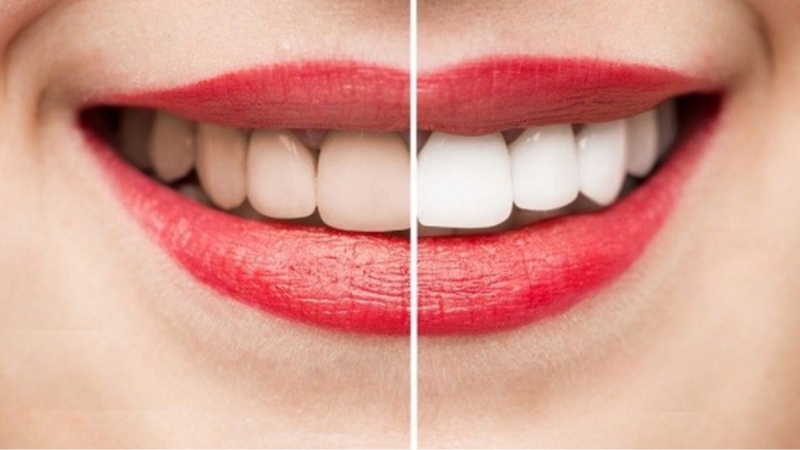 Tẩy trắng răng là giải pháp cải thiện màu răng đơn giản