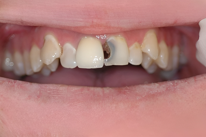 Răng cửa bị sâu đen phải làm sao? 1