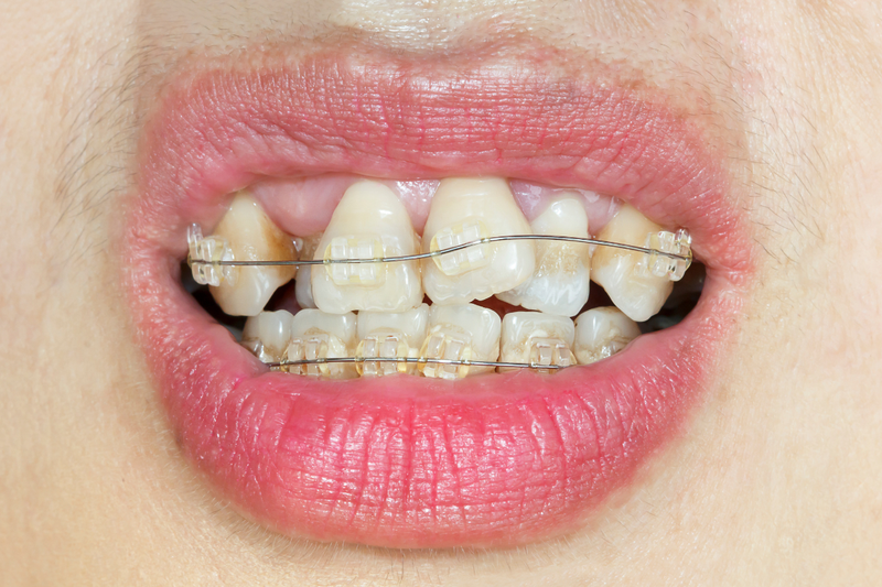 Răng cửa khấp khểnh có nguyên nhân do đâu và cách cải thiện 3