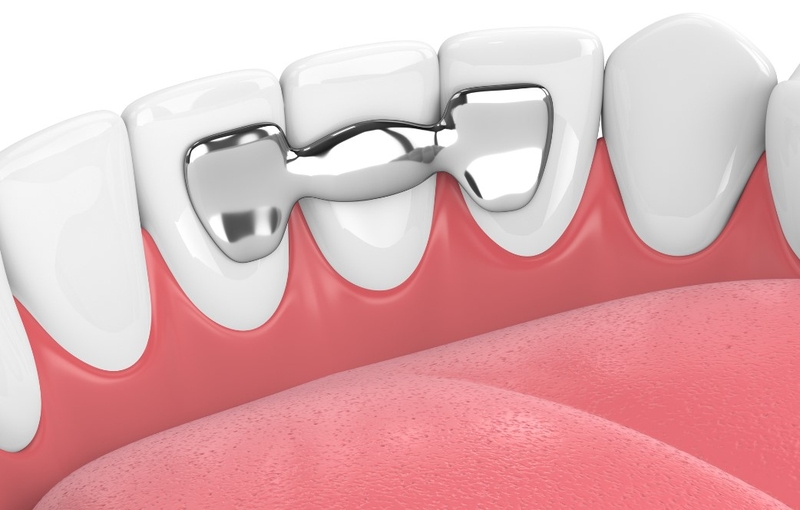 Răng giả tạm thời là gì? Trường hợp nào cần dùng răng giả tạm thời? 2