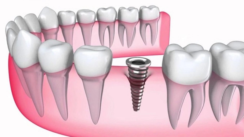 Răng giả tạm thời là gì? Trường hợp nào cần dùng răng giả tạm thời? 3