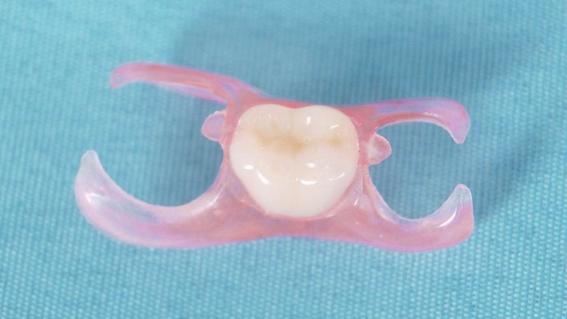 Răng giả tháo lắp 1 chiếc và ưu, nhược điểm của từng loại 1