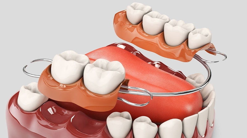Răng giả tháo lắp là gì? Giá răng giả tháo lắp 1
