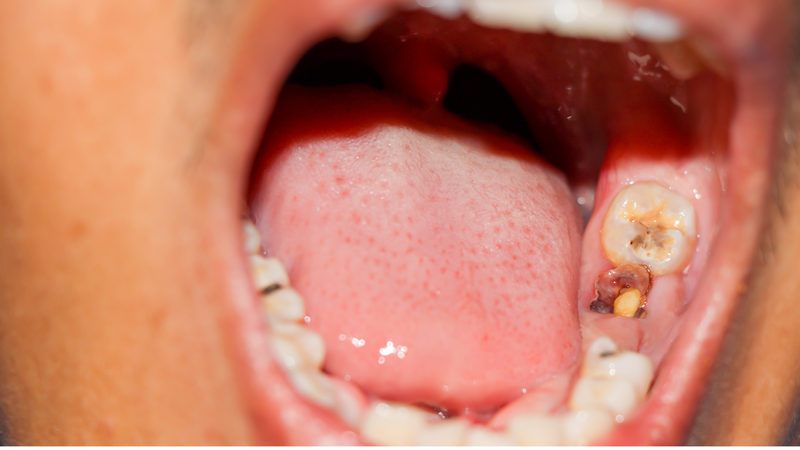 Răng hàm bị vỡ có nguy hiểm không? 2