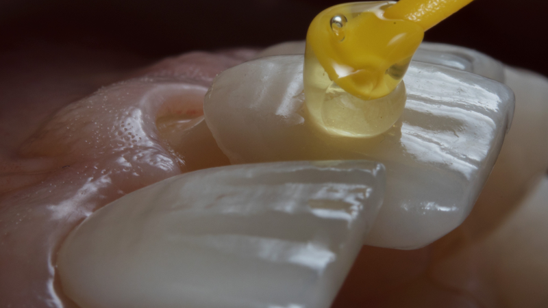 Bảo vệ răng sứ đúng cách giúp hiệu quả sử dụng được bền lâu