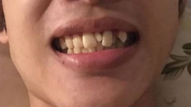 Răng kẹ và những ảnh hưởng của răng kẹ 1