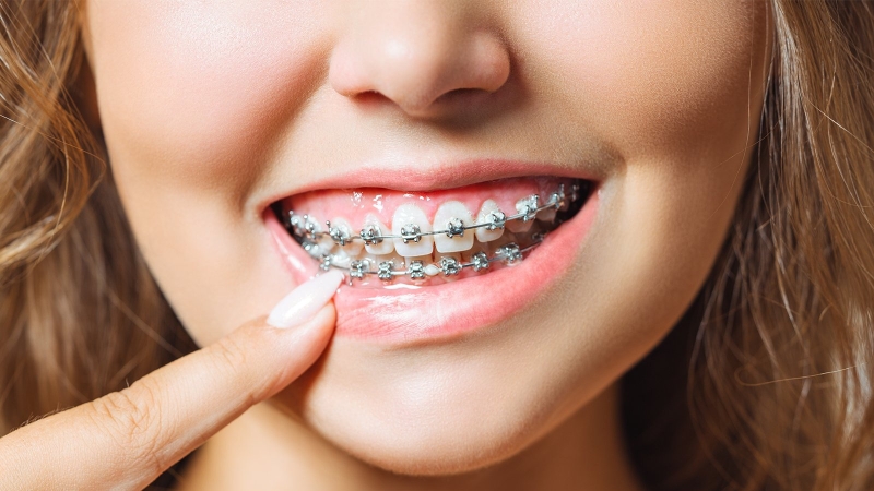 Răng khấp khểnh nên niềng hay bọc sứ tốt hơn? 4