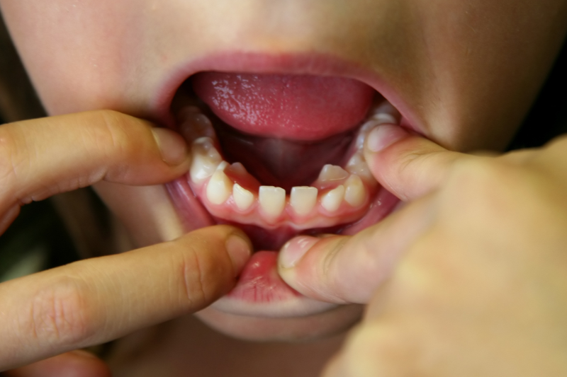 Răng khểnh hàm dưới có đặc điểm gì? 2 cách cải thiện phổ biến hiện nay 2