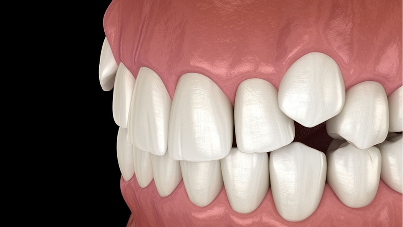 Tìm hiểu răng khểnh là gì