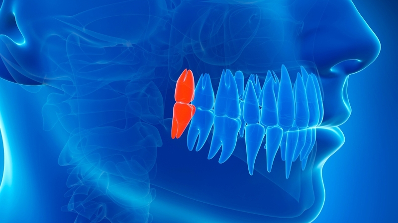 Giải đáp chi tiết răng khôn có mấy cái