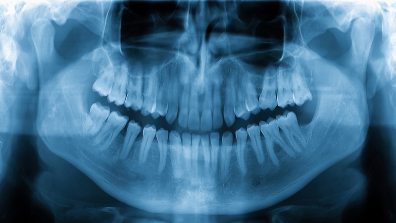 Nhiều người không mọc đủ 4 răng khôn do di truyền hoặc do xương hàm nhỏ