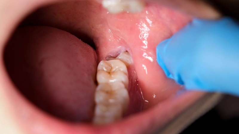 Vệ sinh răng khôn khó khăn có thể làm tăng nguy cơ sâu răng
