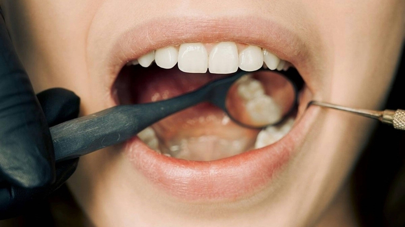 Răng khôn khi nào mọc? Răng khôn xuất hiện phổ biến nhất là từ 17 - 25 tuổi