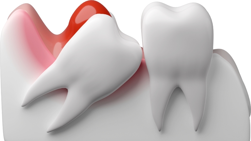 Răng khôn mọc lệch: Dấu hiệu, nguyên nhân và cách xử lý an toàn 1