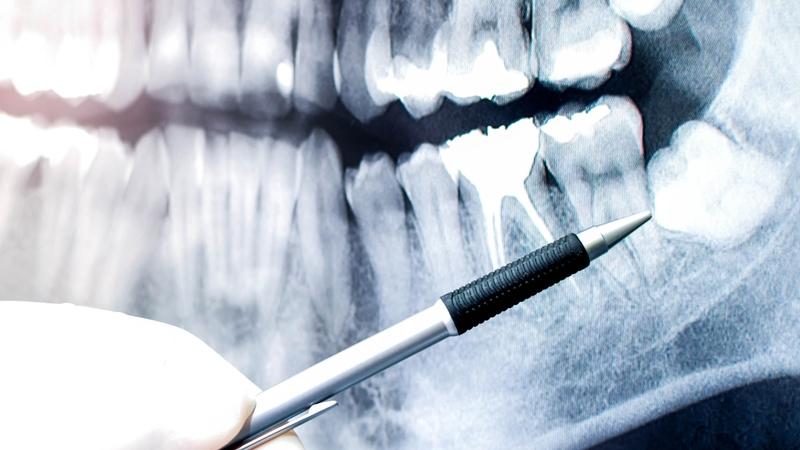 Răng khôn mọc lệch: Dấu hiệu, nguyên nhân và cách xử lý an toàn 4