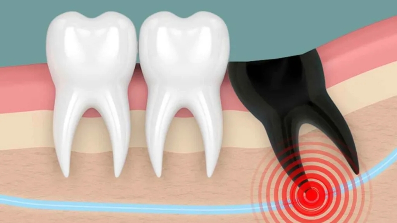 Răng khôn mọc lệch: Dấu hiệu, nguyên nhân và cách xử lý an toàn 6