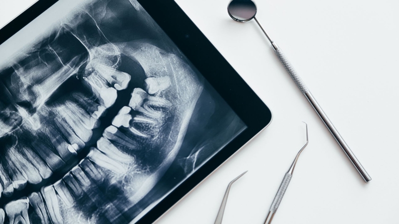 Răng khôn mọc lệch hàm trên: Khi nào cần nhổ? 3