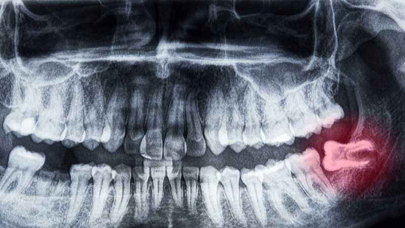 rang-khon-moc-lech-khong-nho-co-sao-khong 1