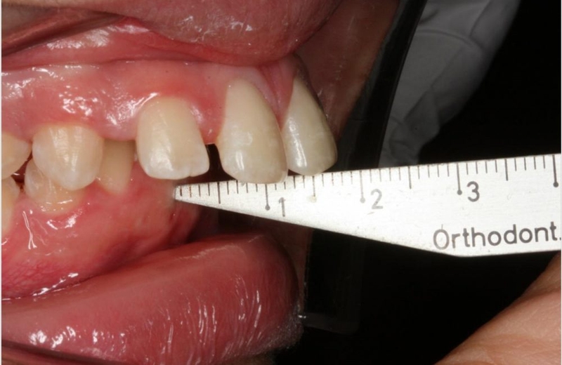 Răng lồi xỉ là gì, nguyên nhân và cách điều trị 1