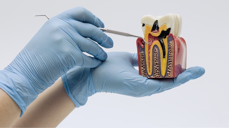 Răng hư tủy có thể bị lung lay mà không gây đau do tủy đã chết