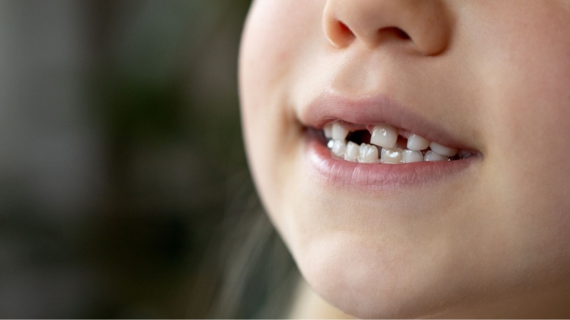 Răng lung lay nhưng không đau có thể là dấu hiệu thay răng sữa ở trẻ em