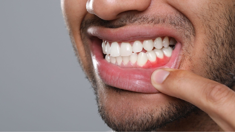 Răng lung lay trong thời gian dài làm gia tăng nguy cơ viêm nướu