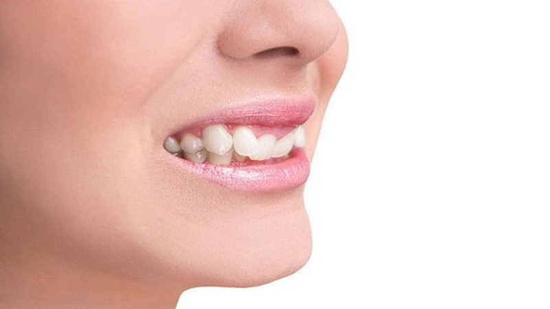Răng mọc lệch vào trong nên làm thế nào? 1