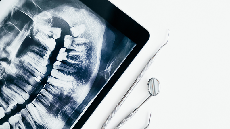 rang-moc-ngam-trong-xuong-co-nguy-hiem-khong-cach-xu-ly-rang-moc-ngam-trong-xuong 1.png