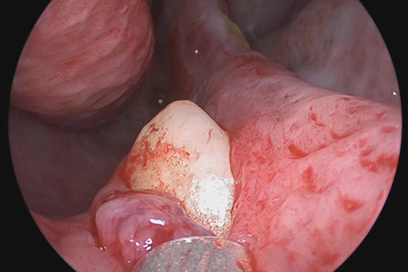 Tìm hiểu chi tiết về tình trạng răng mọc ngược 2