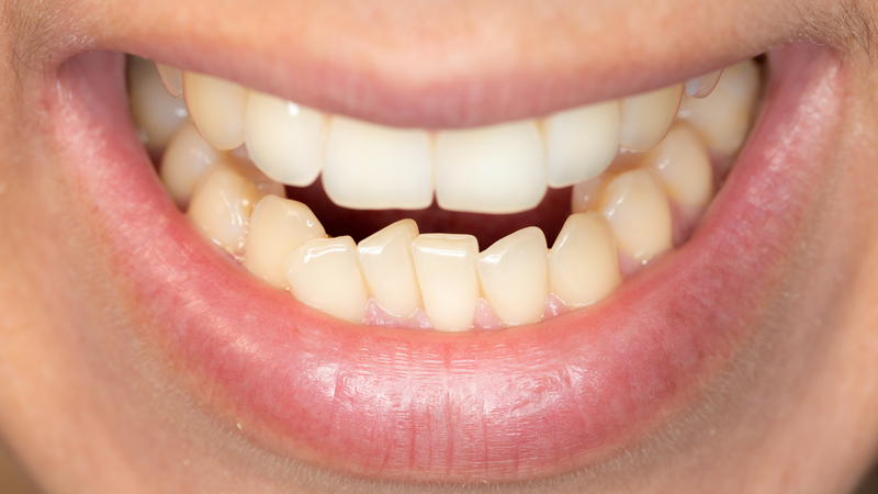 Người bị răng móm thường rất dễ nhận biết