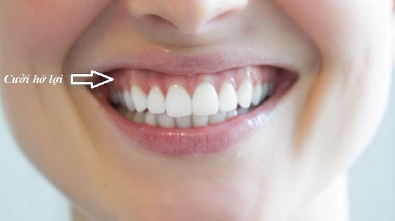 Răng ngắn nên làm gì? Nguyên nhân và cách khắc phục răng ngắn 3