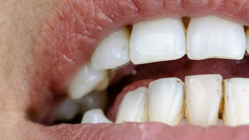 Răng nhiễm kháng sinh do ảnh hưởng của một số loại thuốc kháng sinh