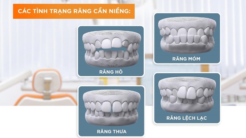 Răng như thế nào thì nên niềng? Các phương pháp niềng răng phổ biến 1