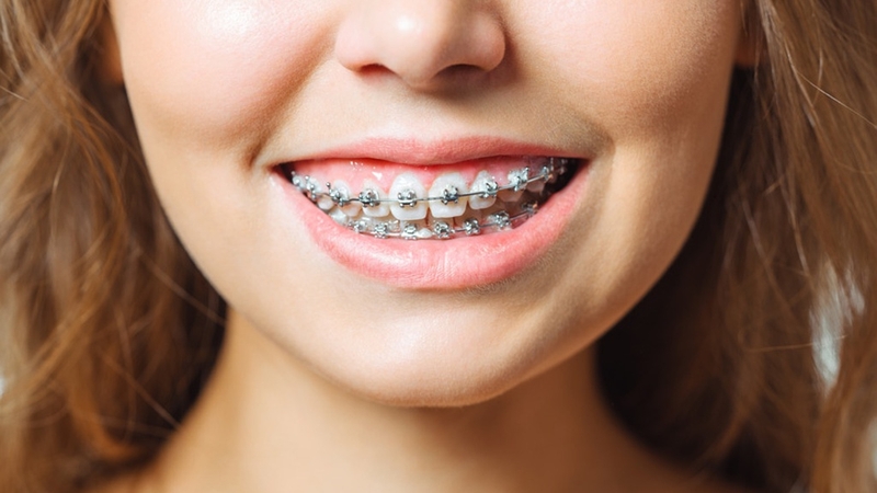 Răng như thế nào thì nên niềng? Các phương pháp niềng răng phổ biến 3