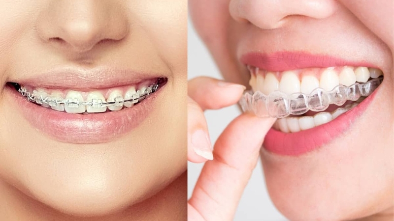 Răng như thế nào thì nên niềng? Các phương pháp niềng răng phổ biến 2