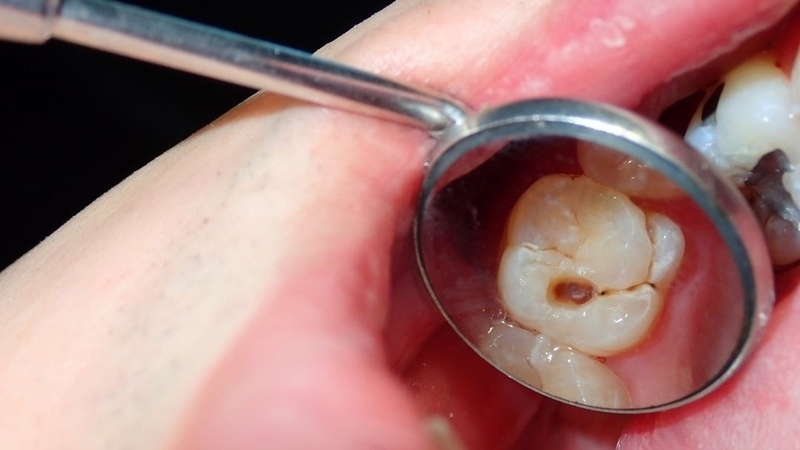 Răng sâu bị thối là do sâu răng kéo dài gây viêm tuỷ, hoại tử