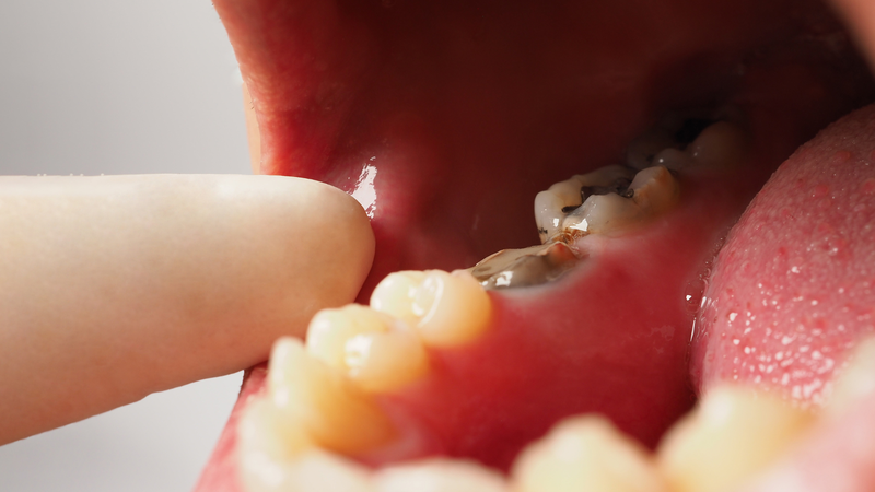 Răng sâu vỡ nặng chỉ còn chân răng thường do không điều trị kịp thời
