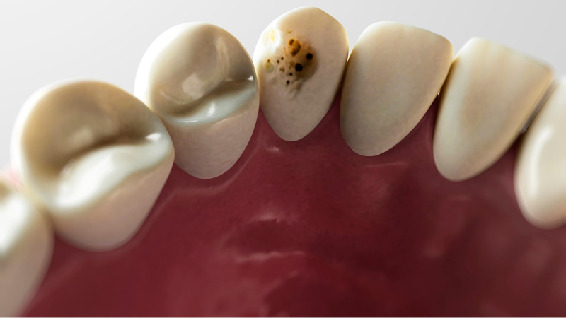 Răng sâu bị vỡ có trám được không? 1