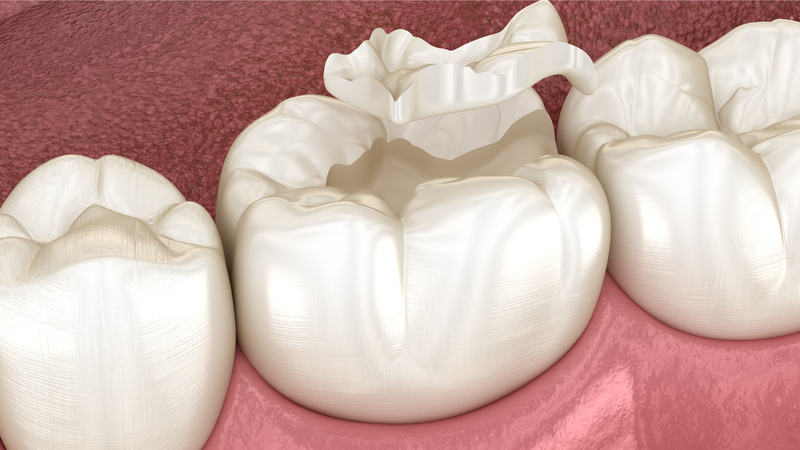 Răng sâu bị vỡ có trám được không? 2