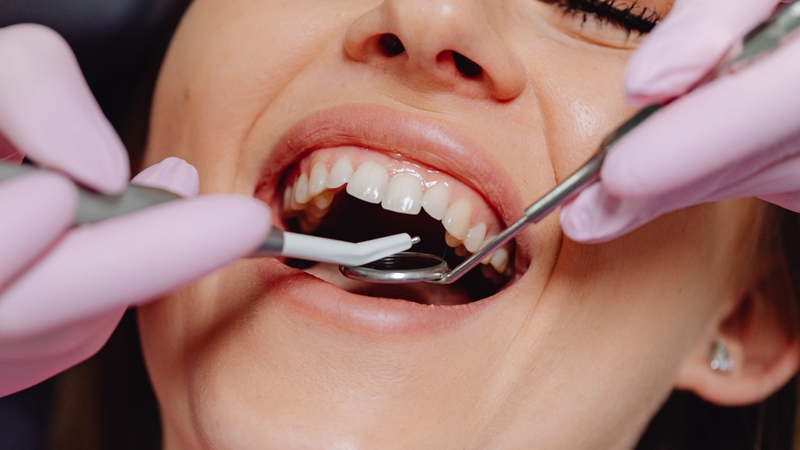 Trám giúp đóng kín lỗ sâu, giảm ứ đọng thức ăn